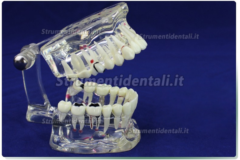 ENOVO Modello malattie dentali demo